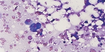 Antimetabolitler: Kanserle Mücadelede Umut!