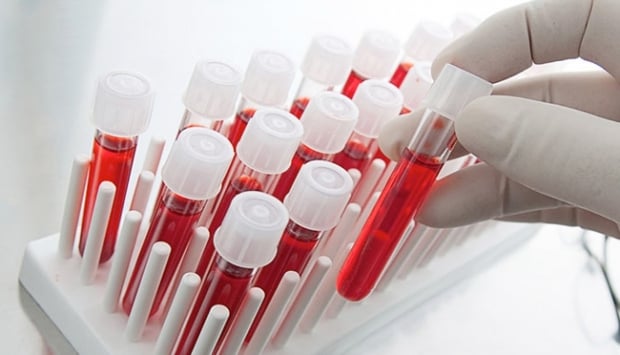 1729521203 808 A Kan Grubu Felc Riskini Artiriyor Felç riski