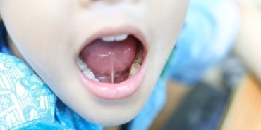Çocuklarda Dil Bağı: Erken Teşhisin Önemi