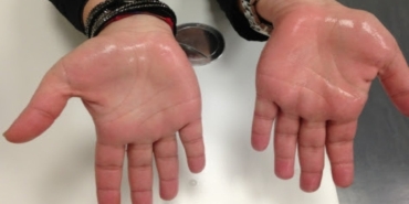 El Terlemesine Etkili Çözüm: ETS Ameliyatı