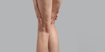 Lipödem: Kadınlar İçin Görünmeyen Tehlike!