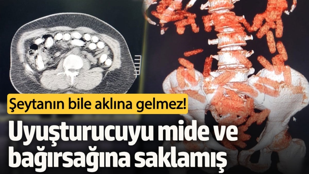 Şeytanın bile aklına gelmez! Uyuşturucuyu mide ve bağırsağına saklamış