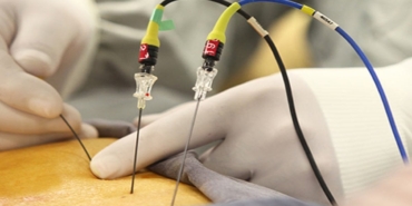 Radyofrekans ile Fıtık Ağrısına Son!