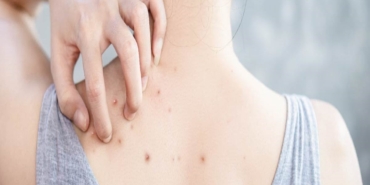 Sırtta Sivilce Mi, Tehlikeli Hastalık Mı?