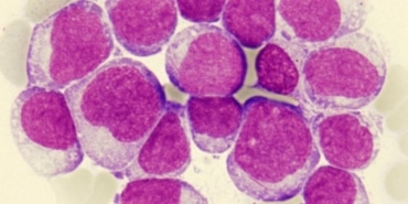 Siyah AML Hastaları İçin Genetik Bulgular Önemli