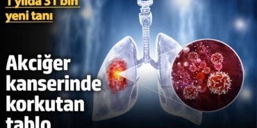 Akciğer Kanseri: 31 Bin Yeni Tanı, 25 Bin Ölüm!