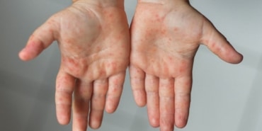 El-Ayak-Ağız Hastalığı Erişkinleri de Tehdit Ediyor!