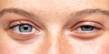 Göz Kapağı Ameliyatı Öncesi Dikkat Edilmesi Gerekenler