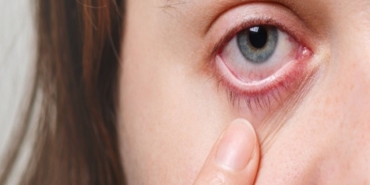 Kış Aylarında Göz Enfeksiyonlarına Dikkat!