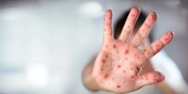 Kızamık Vakaları Artıyor: Korunma Yöntemleri