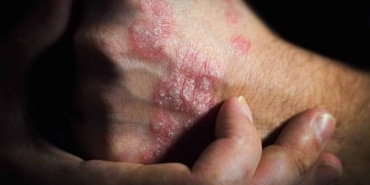 Sedef Hastalığı: Belirtiler ve Yönetim Yöntemleri