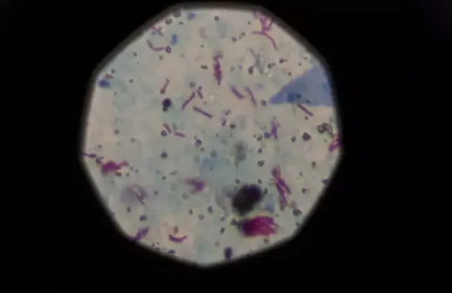 Tuberkuloz 2023te COVIDi Geride Birakti.webp 7y7.webp