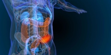 Kolon Kanseri Artışta