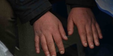 Soğuktan Cilt Kurtarma