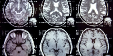 Yağlanma Alzheimer Riskini Artırıyor